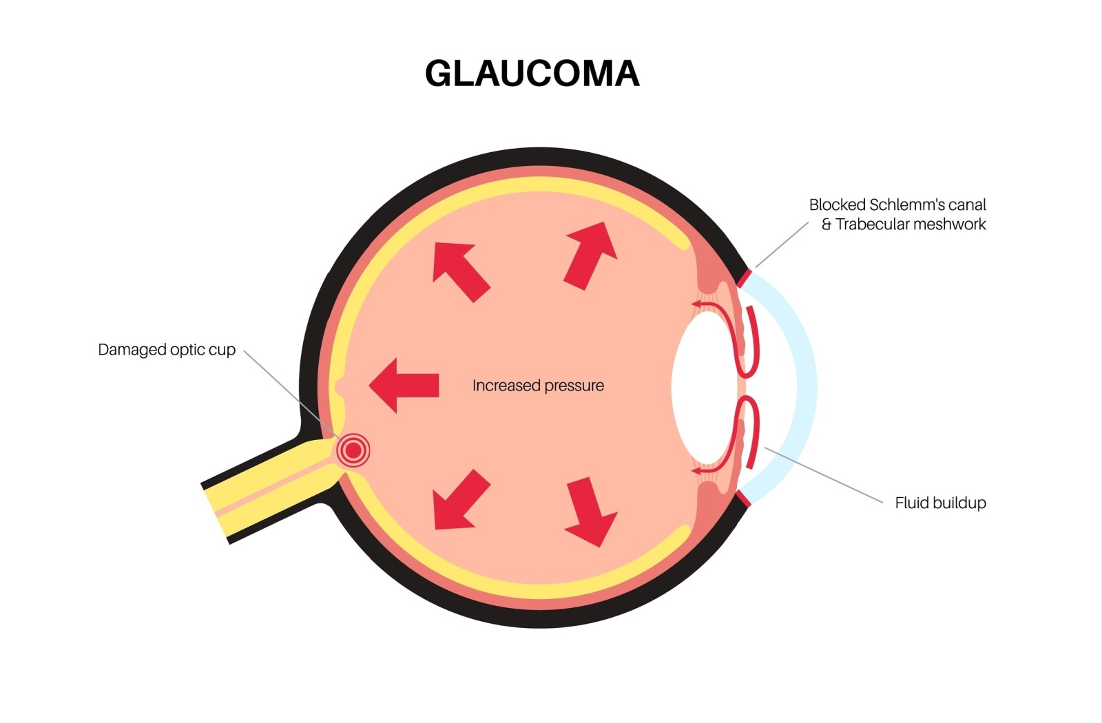 Glaucoma illustration showing increased pressure, fluid build up, and damaged optic nerve.