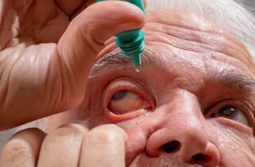 An older adult holds their bottom eyelid open as they instill their glaucoma eye drop medication.