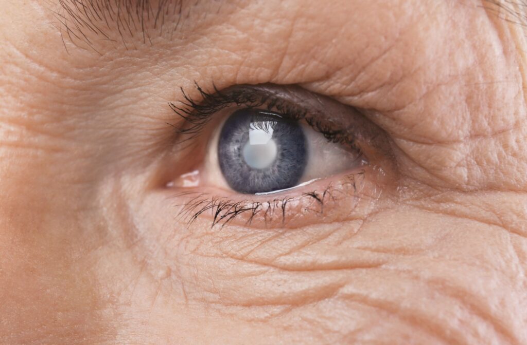 A closeup of the eye of an adult with a cloudy lens due to cataracts.