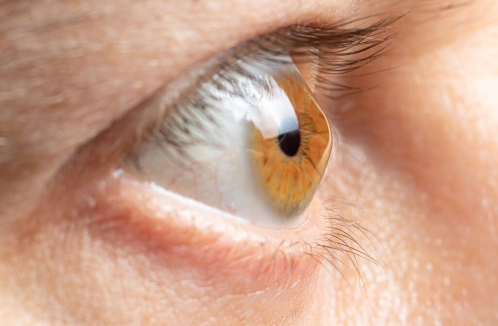 Close-up of a human eye showing the cone-shaped bulge of the cornea caused by keratoconus.
