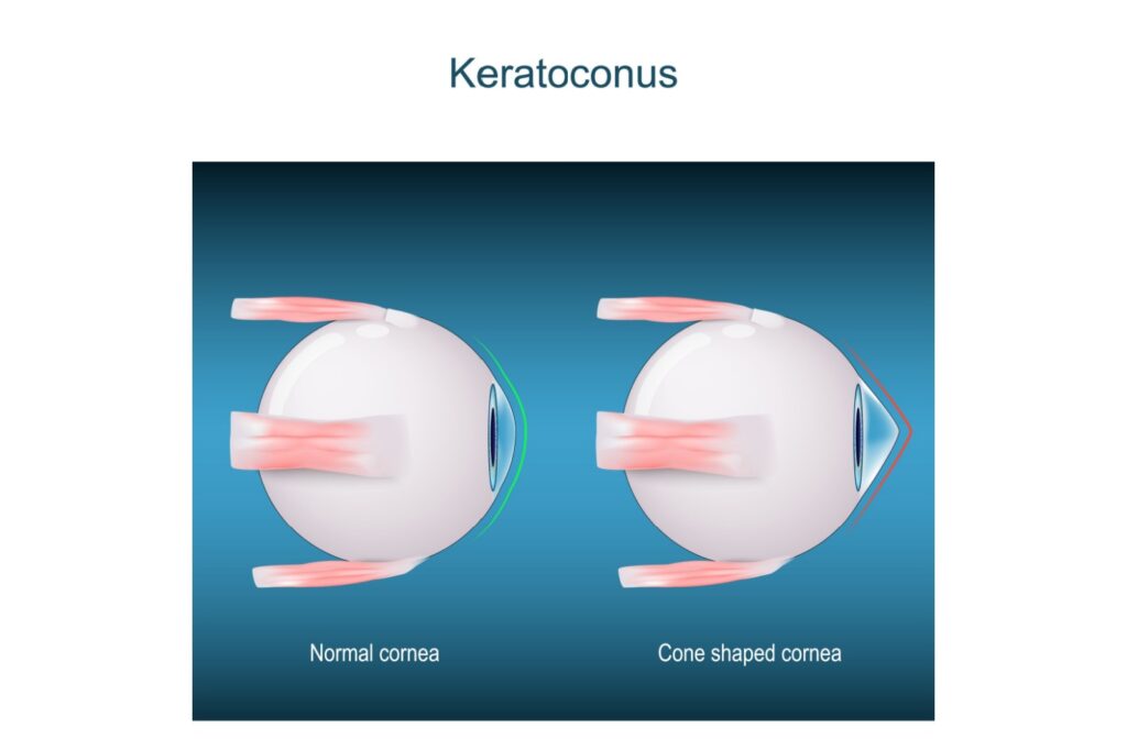Close-up of a human eye showing the cone-shaped bulge of the cornea caused by keratoconus.