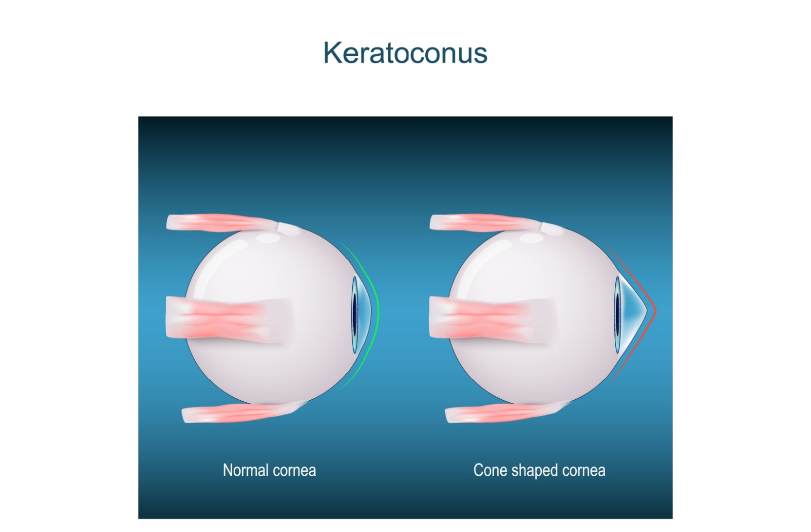 Can Keratoconus Be Cured