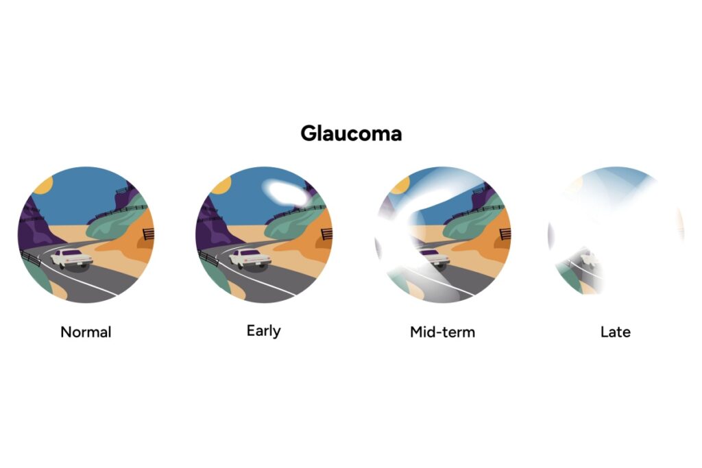 Series of four circular images illustrating how vision changes with glaucoma, progressing from normal vision to early, mid-term, and late-stage tunnel vision with increasing visual field loss.