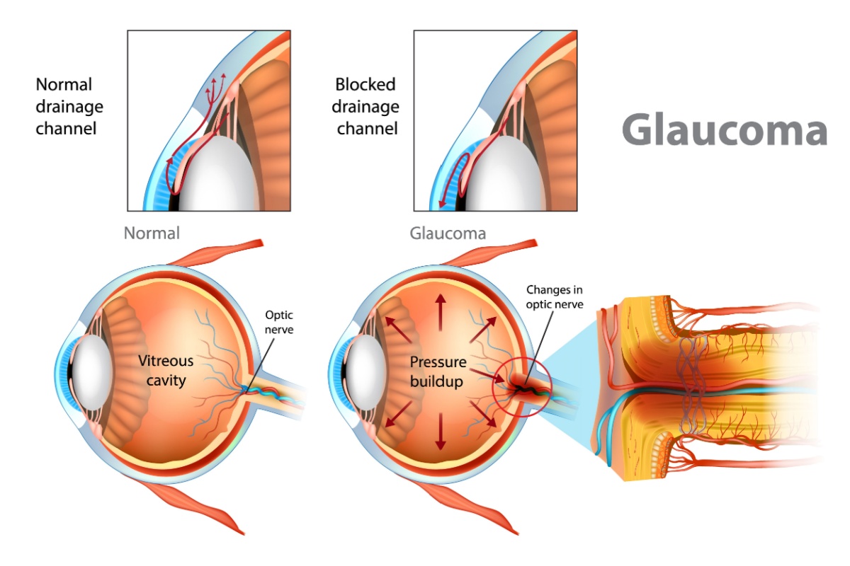 Medical illustration showing the difference between a normal eye and an eye with glaucoma, including blocked drainage channels, increased pressure buildup inside the eye, and resulting optic nerve damage.